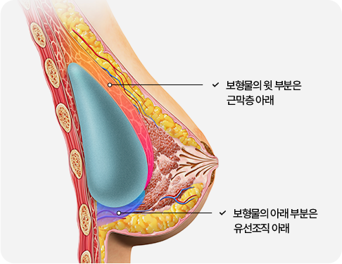 부산 가슴성형 듀얼플레인 수술법
