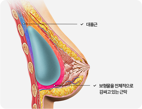 부산 가슴성형 근막하 삽입 수술법