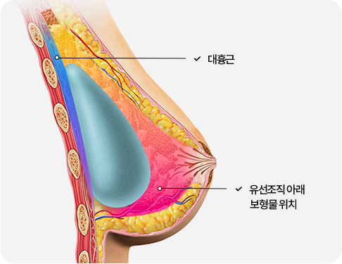 부산 가슴성형 유선안 삽입 수술법