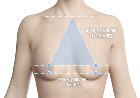 유방하수 단계별 처진가슴 기준 설명 이미지