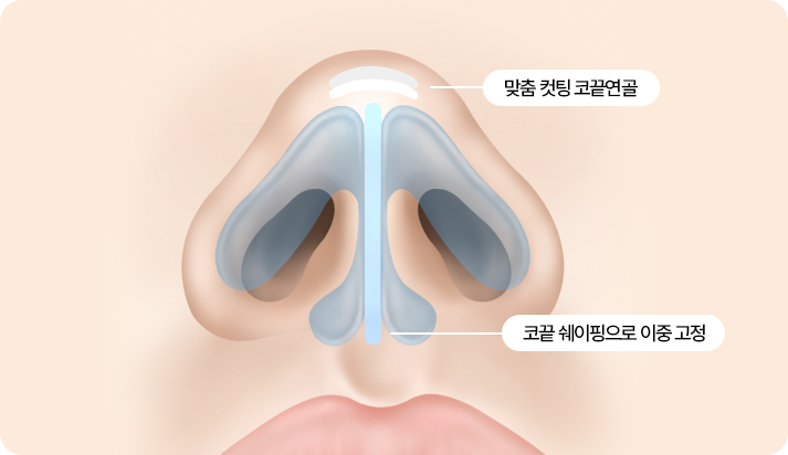 부산 서면 코끝성형 쉐이핑 고정 구조