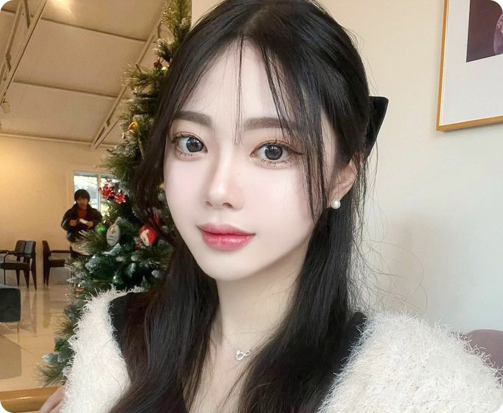 부산 비절개 눈매교정 수술 대상 눈매 개선 사례