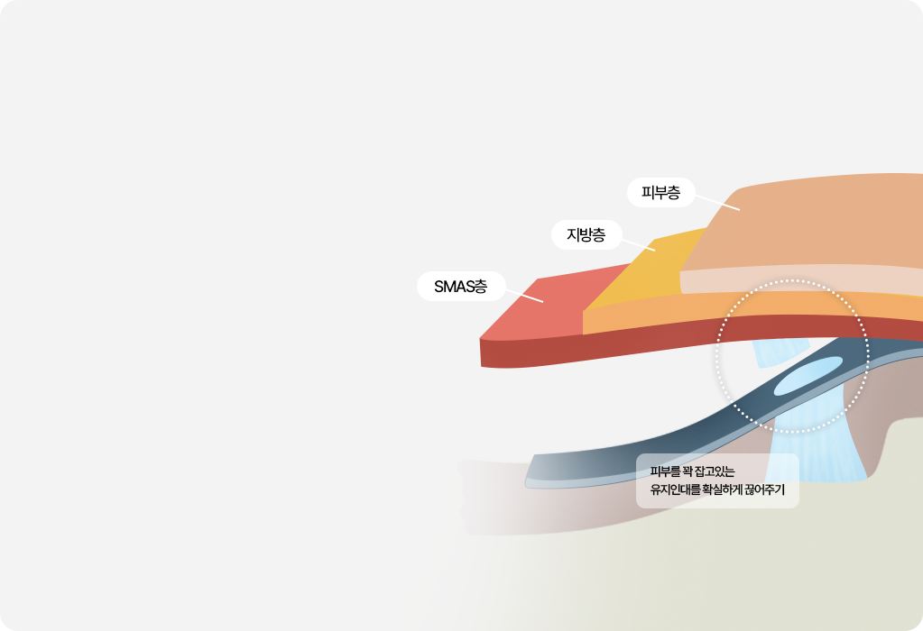 부산 미니리프팅 유지인대 박리
