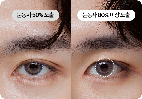 남자 안검하수 교정 눈동자 노출 개선 이미지