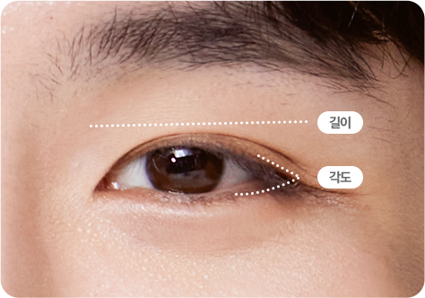 부산 남자 트임성형 눈 길이 확장 디자인