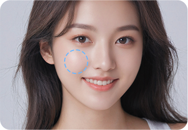 앞광대 자가지방이식