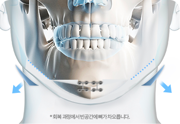 턱끝 절골 후 고정 단계