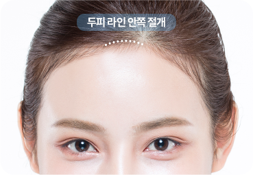 이마보형물 두피 절개 삽입 수술 단계
