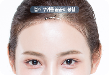 이마보형물 봉합 및 회복 단계