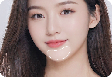 앞턱 맞춤 보형물 제작