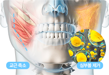 교근축소 및 심부볼 제거