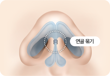 부산 서면 코끝성형 연골 묶기 적용 경우