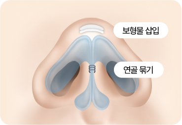 부산 서면 코끝성형 연골 추가 적용