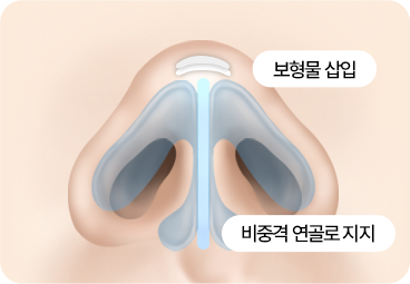 부산 서면 코끝성형 지지대 보강 방식