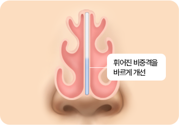 부산 남자 기능코수술 비중격 교정 과정