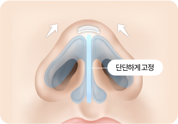 부산 남자 기능코성형 구조 지지 고정 과정