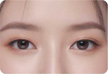 부산 눈재수술 쌍꺼풀 라인이 낮은 경우 재수술