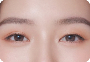 부산 눈재수술 쌍꺼풀 라인 비대칭 교정 사례