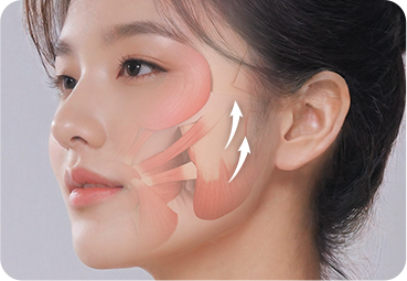 부산 미니리프팅 유지인대 박리 과정