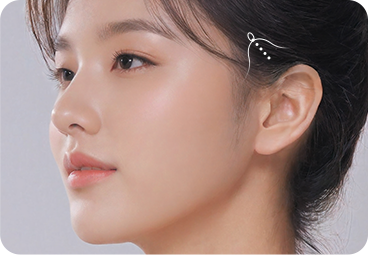 부산 미니리프팅 3중 봉합 과정