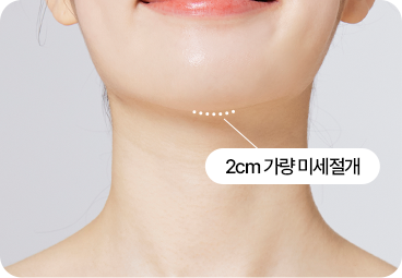 부산 이중턱 근육묶기 턱밑 최소 절개 과정