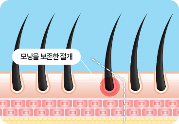 부산 서면 절개 모발이식 봉합 흉터 최소화
