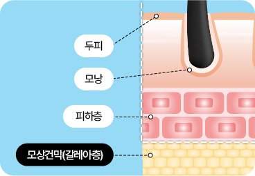 부산 서면 절개 모발이식 갈레아층 보존 절개