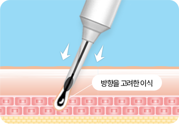 비절개 모발이식 식모기 이식 과정
