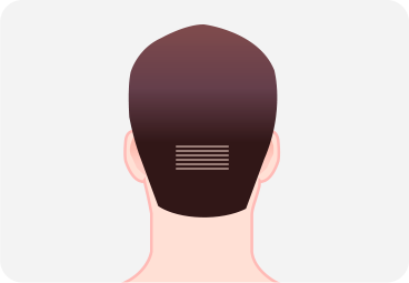 비절개 모발이식 하이드컷 방식
