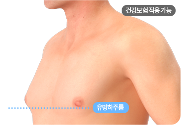 부산 남자 여유증 2-1단계 유형