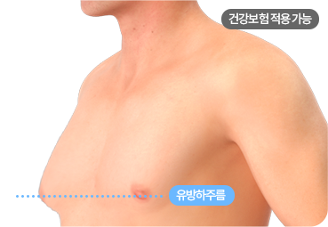 부산 남자 여유증 2-2단계 유형