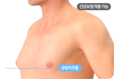 부산 남자 여유증 3단계 유형