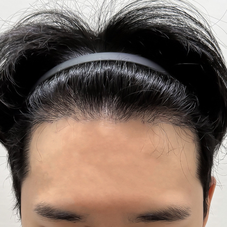 모발이식 9개월차
